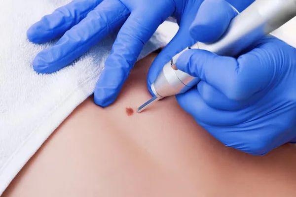 Mole Removal