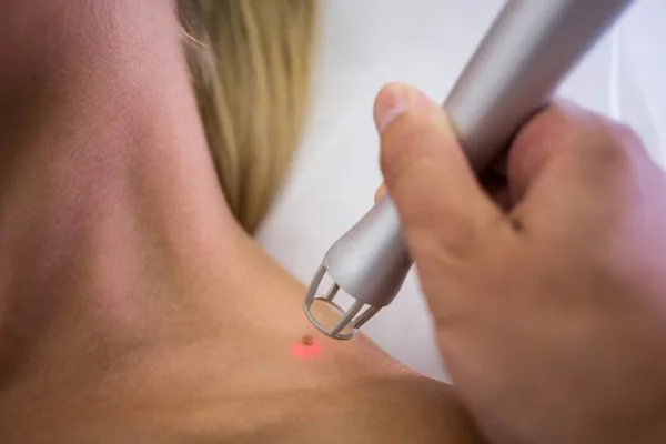 Tatto And Birth Mark Removal