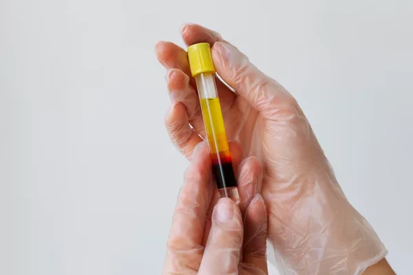 Platelet Rich Plasma