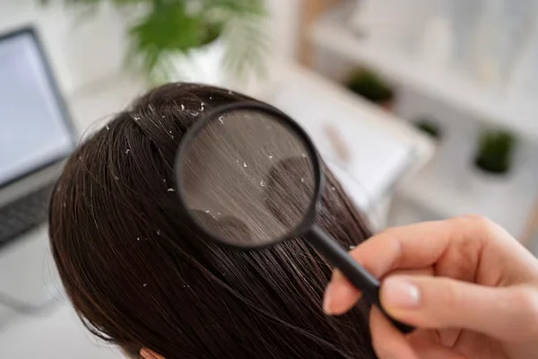 Dandruff Treatment