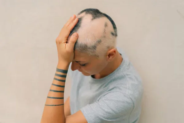 Alopecia Areata